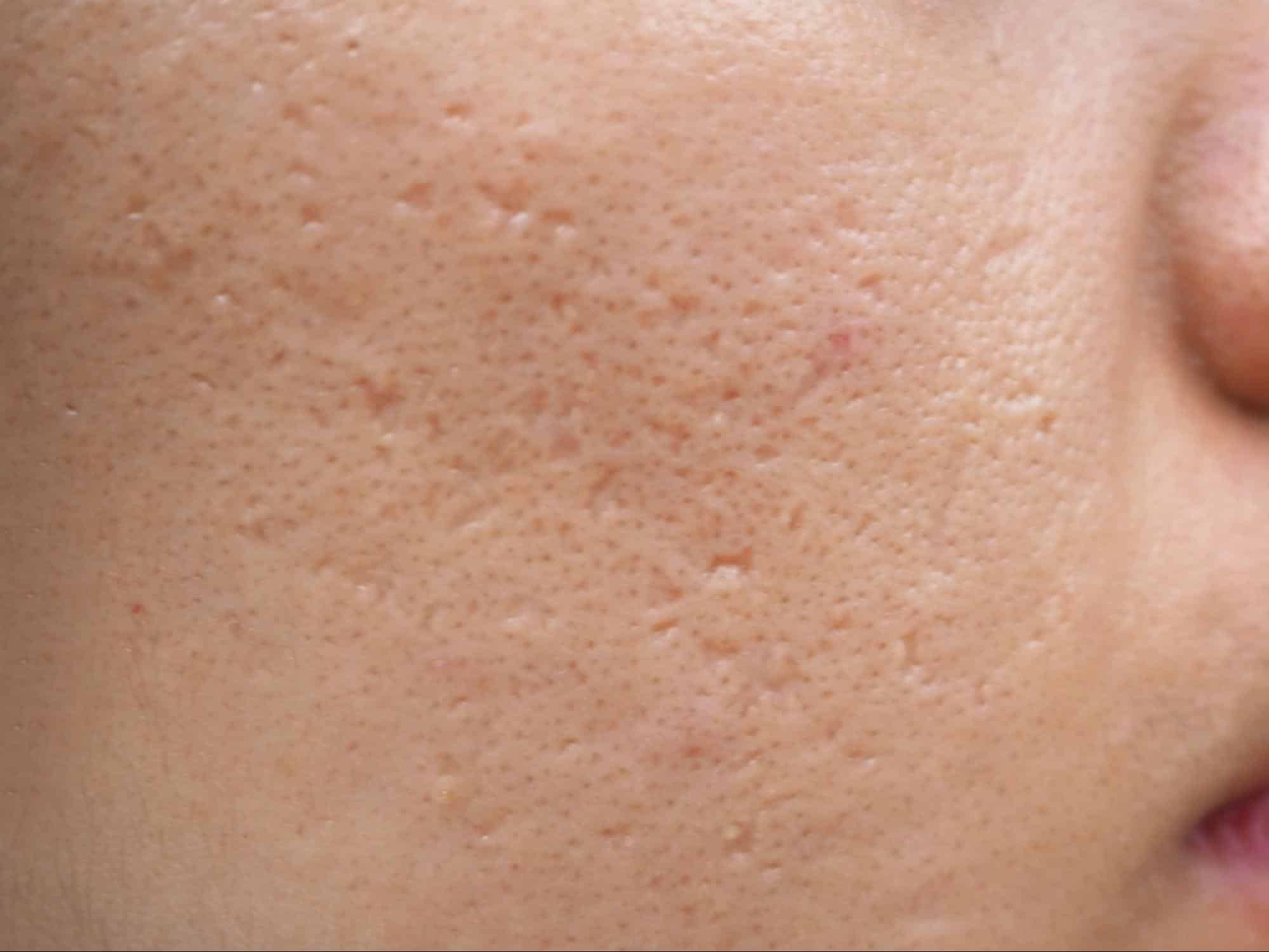 หน้าเป็นหลุมสิว Ice Pick Scar