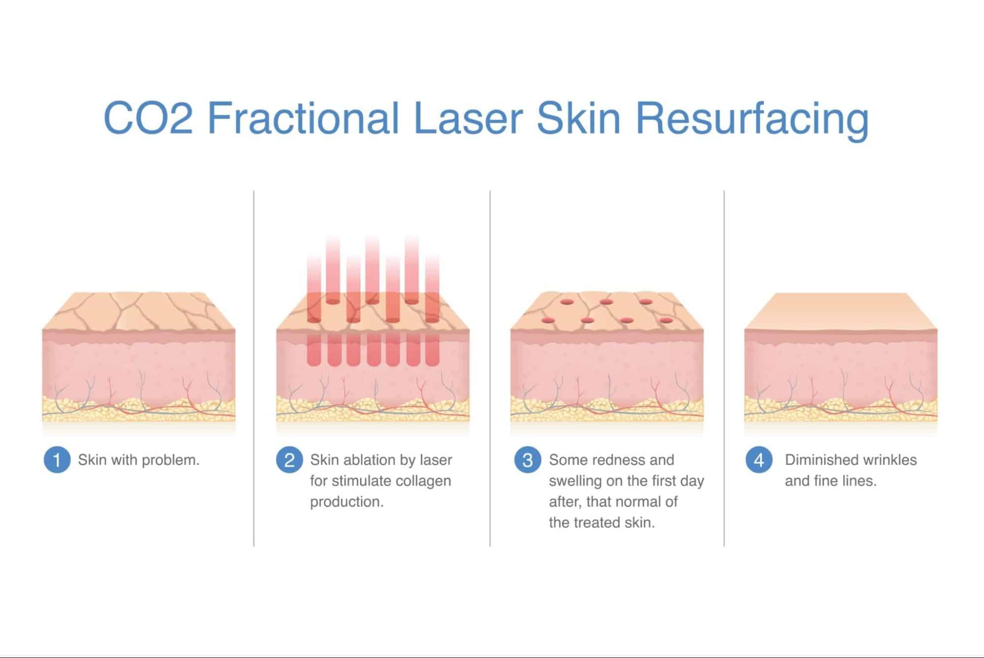 หลักการทำงานของ Fractional CO2 Laser