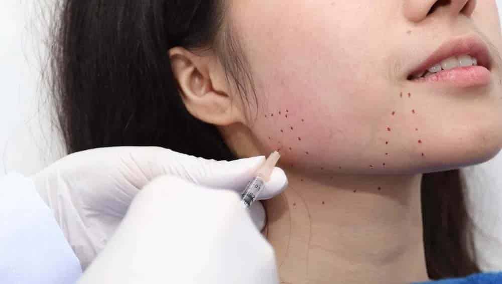 หลังฉีดโบกราม หน้าเปลี่ยนไหม