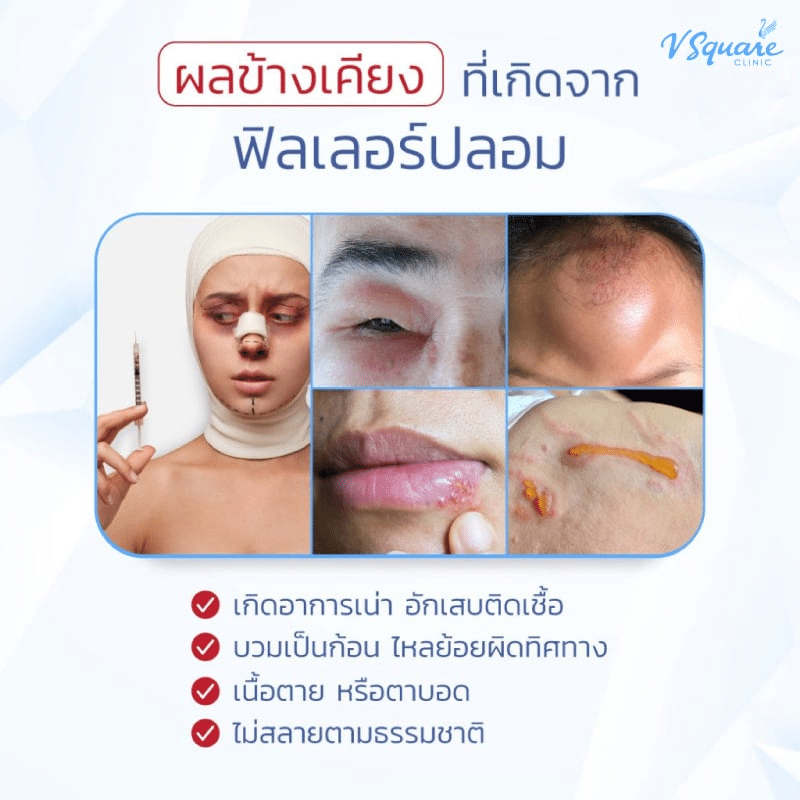 อาการจากฟิลเลอร์ปลอม