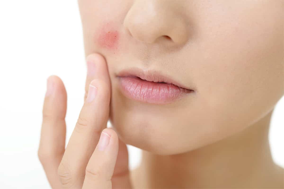 อาการบวมแดงหลังทำ Hifu