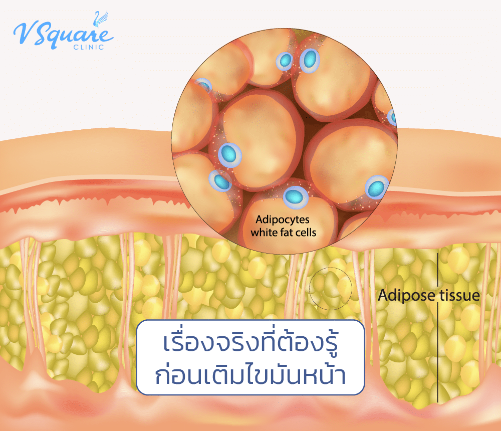 เติมไขมันหน้า