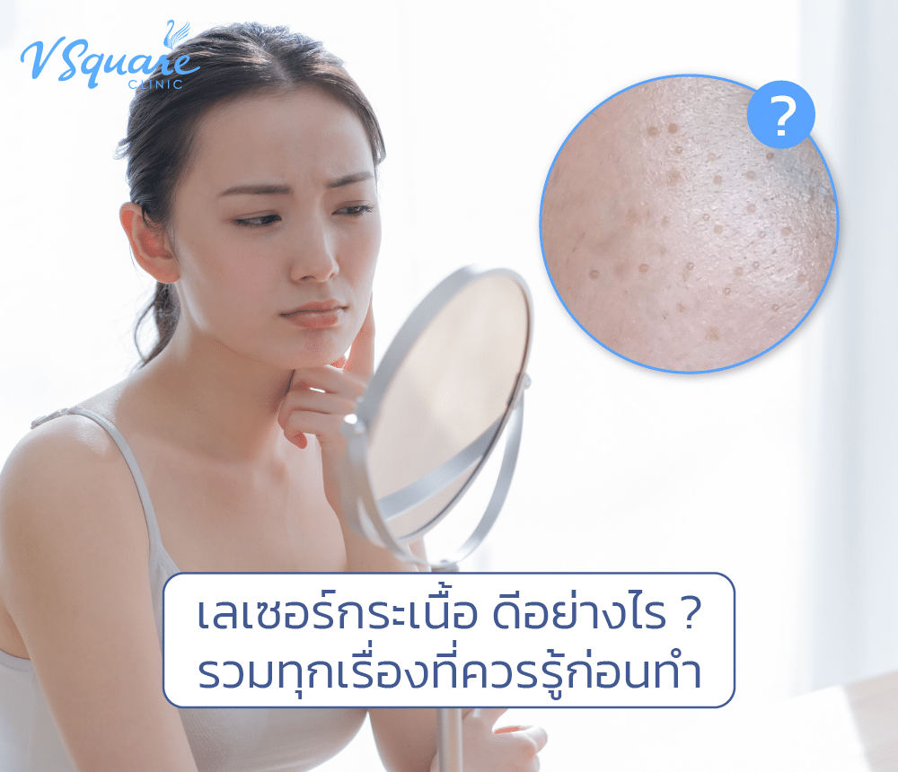 เลเซอร์กระเนื้อ