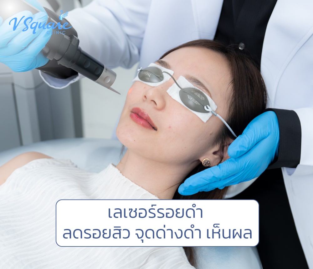 เลเซอร์รอยดำ