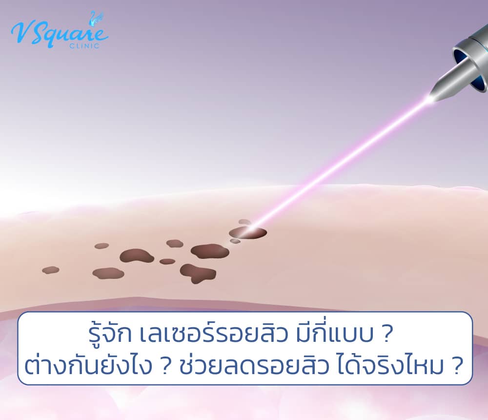 เลเซอร์รอยสิว