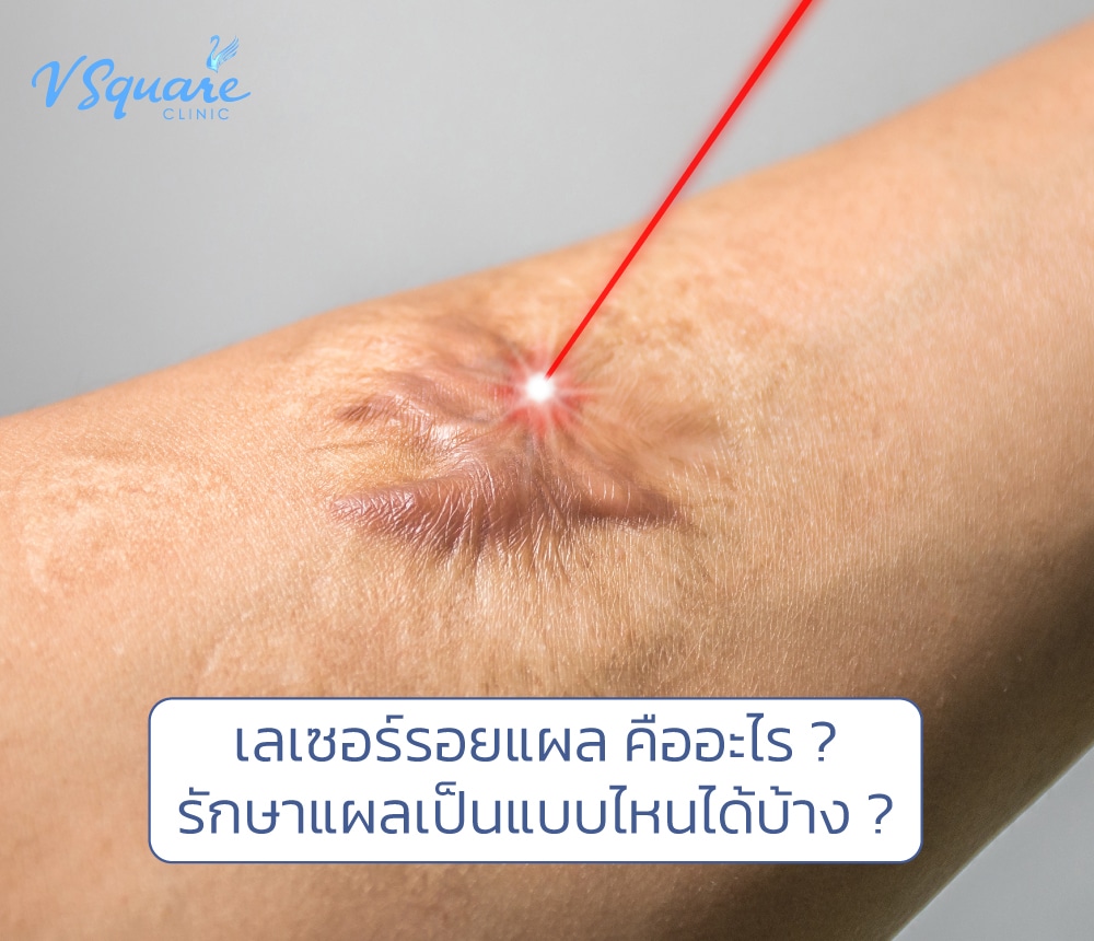 เลเซอร์รอยแผล