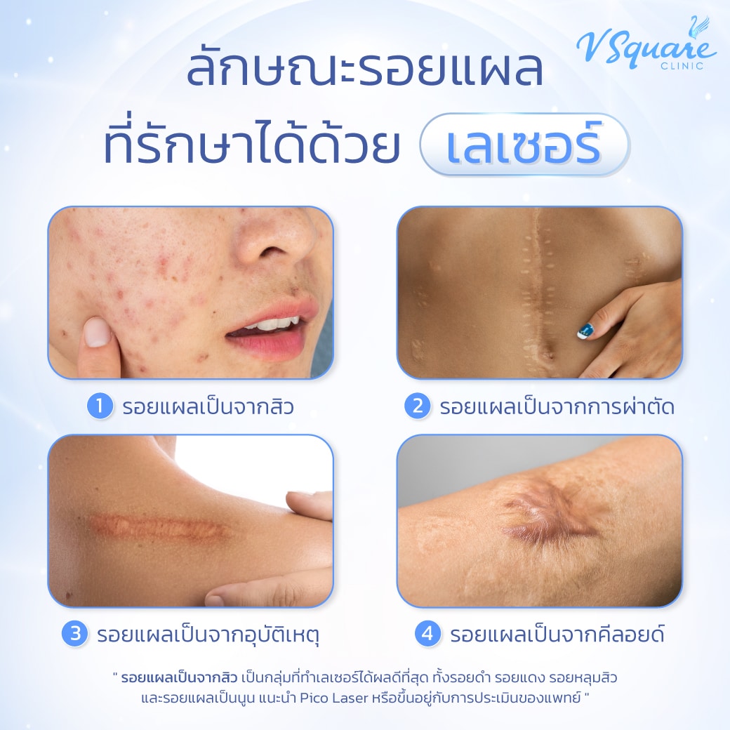เลเซอร์รอยแผลแบบไหนได้บ้าง