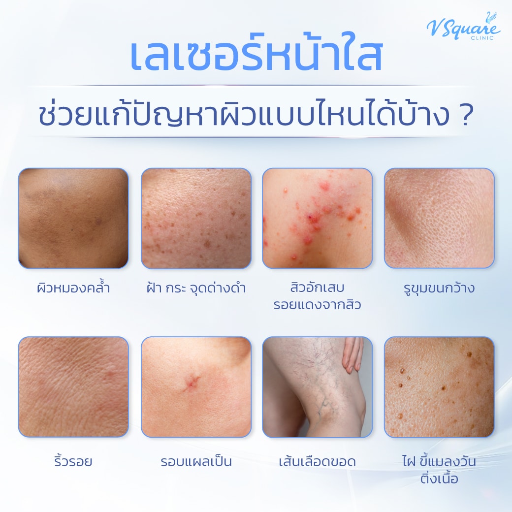เลเซอร์หน้าใส เหมาะกับปัญหาผิวแบบไหน