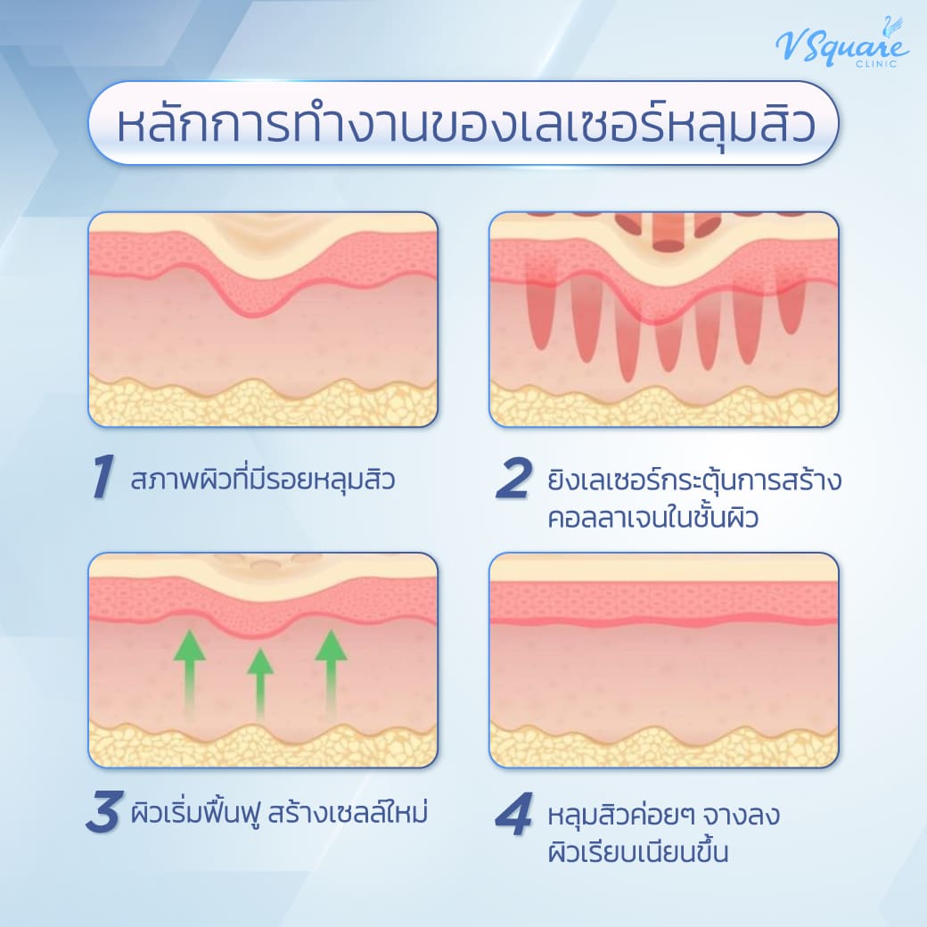 เลเซอร์หลุมสิว(1)