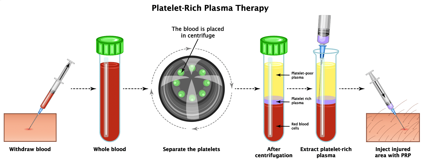 PRP หลุมสิว
