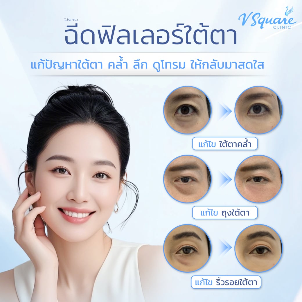 ฉีดฟิลเลอร์ใต้ตา ลดขอบตาดำ