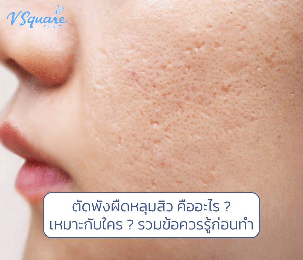 ตัดพังผืดหลุมสิว