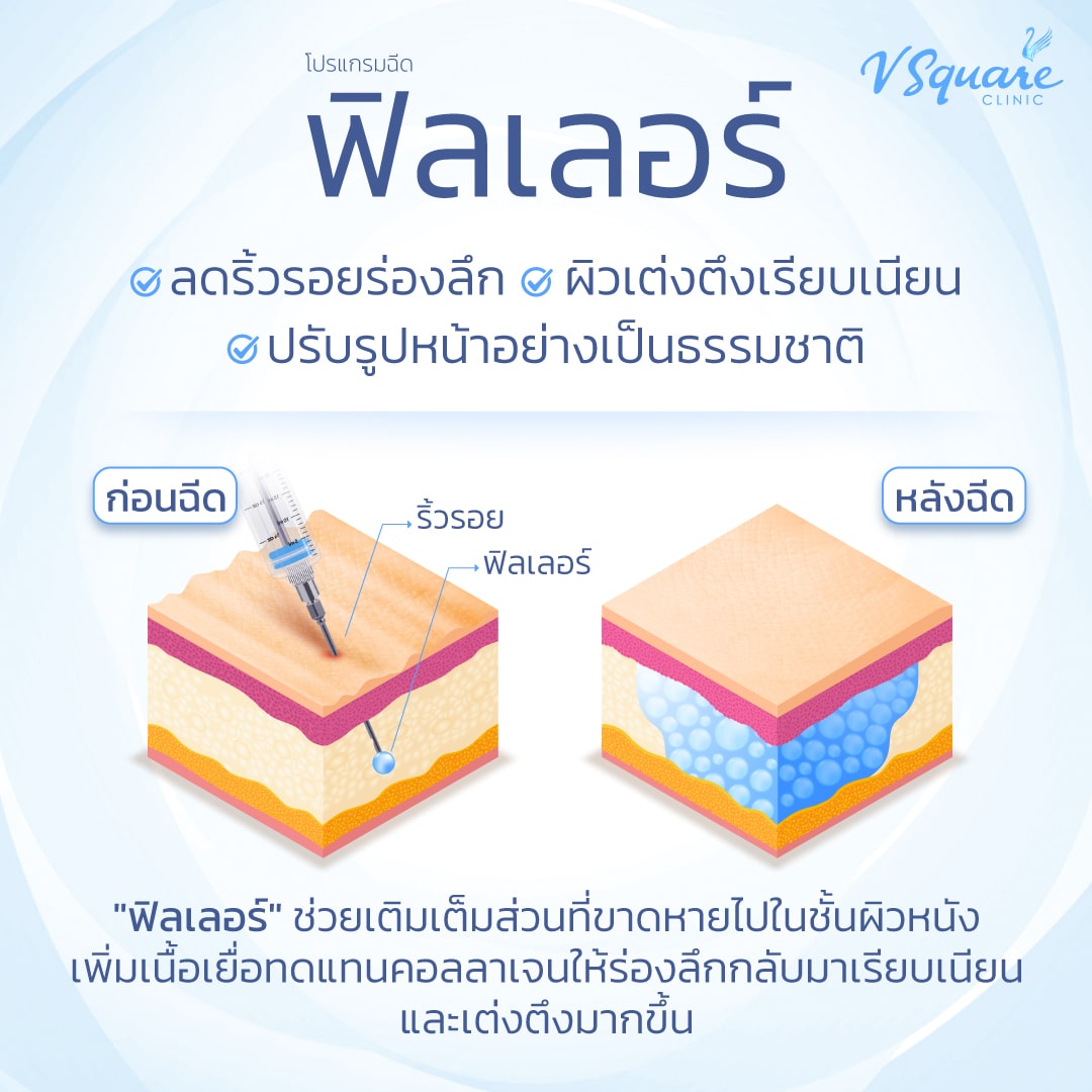 ฟิลเลอร์หลุมสิว