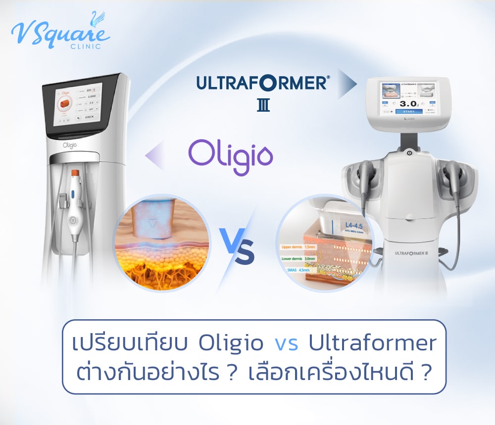 Oligio vs Ultraformer