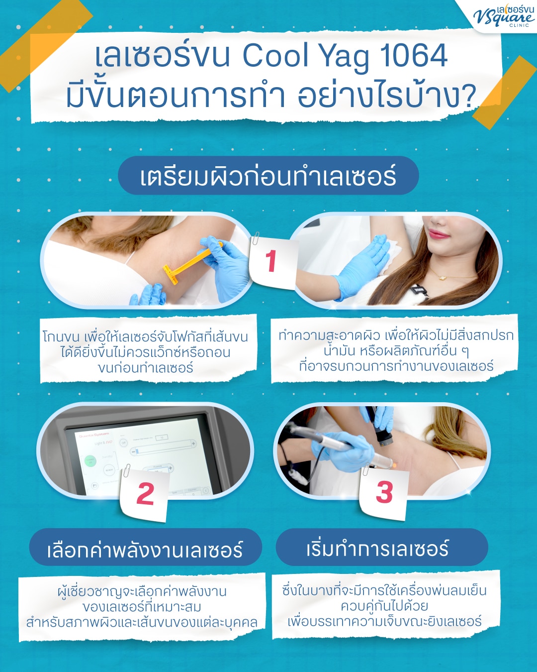 ขั้นตอนเครื่องเลเซอร์ขน