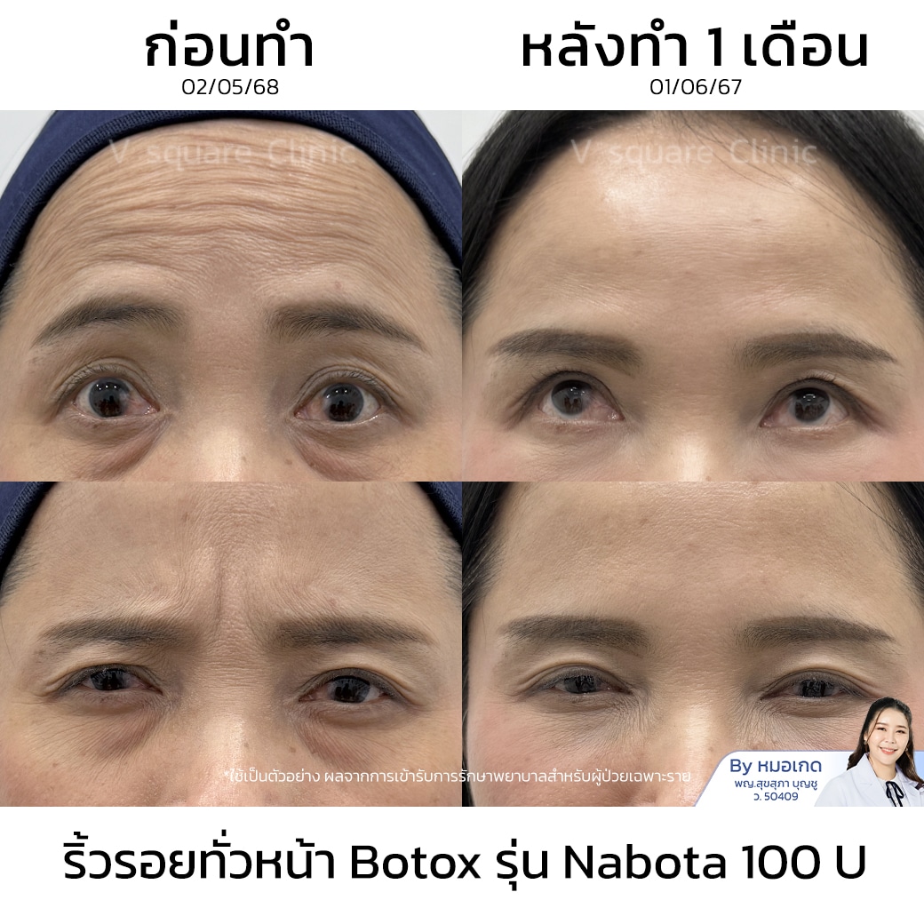 ฉีดโบท็อก_คุณเนตร