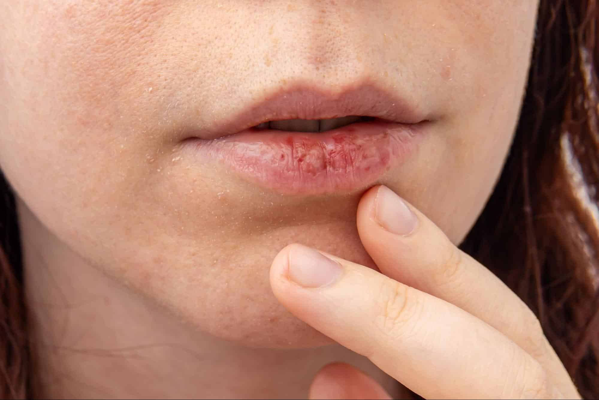 ปากแห้ง อันตรายไหม