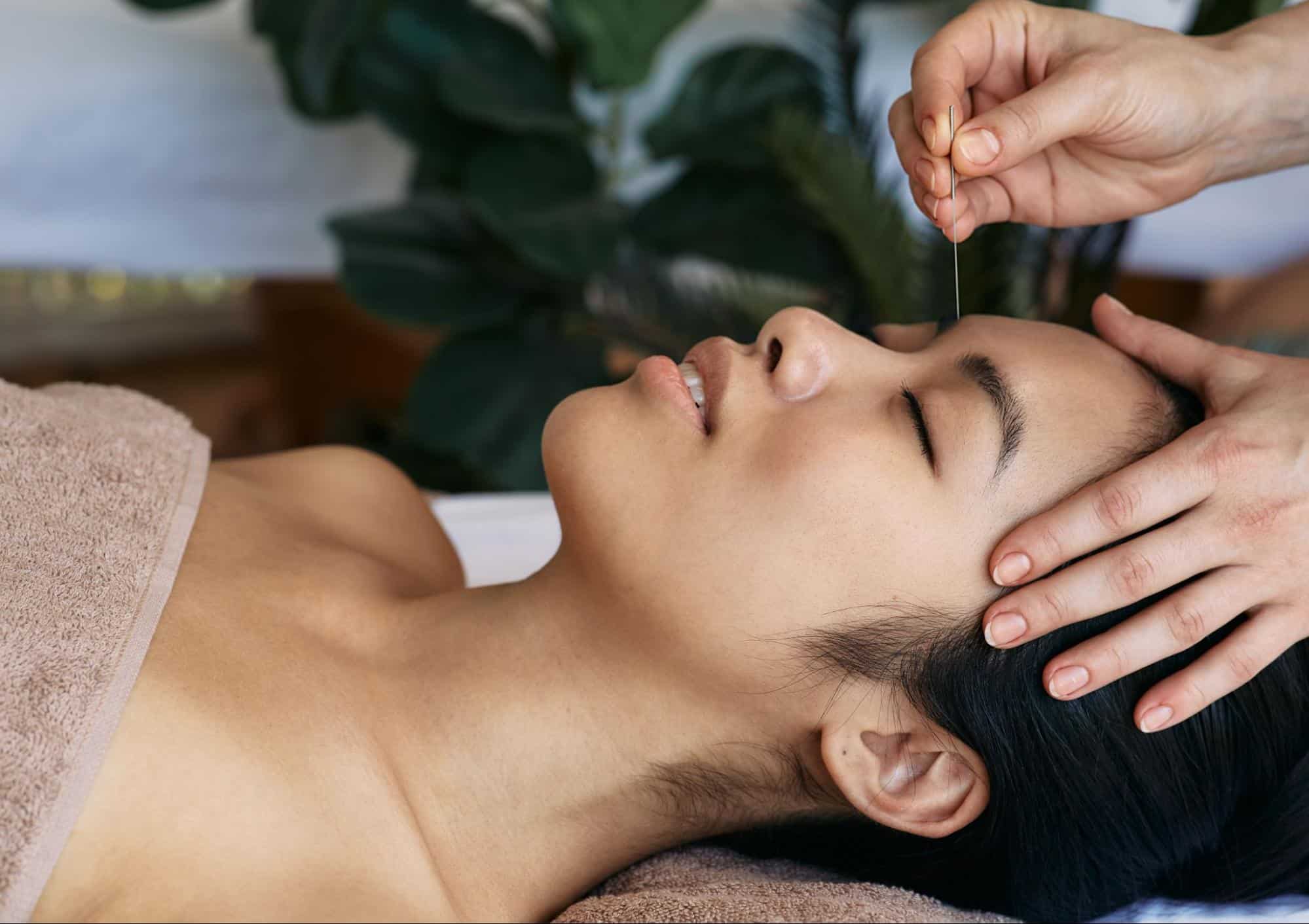 ฝังเข็มไมเกรน