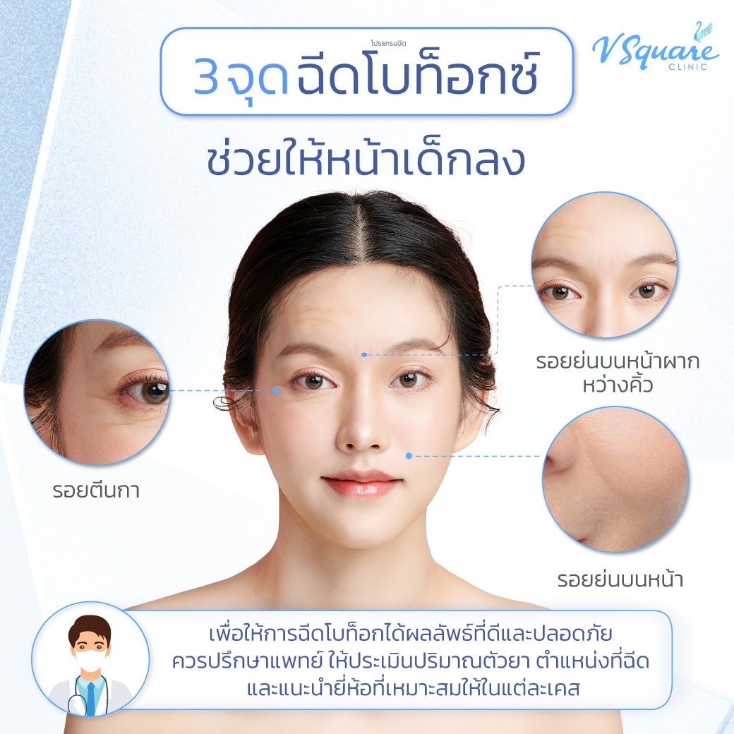 รวมจุดฉีดโบท็อกลดริ้วรอย
