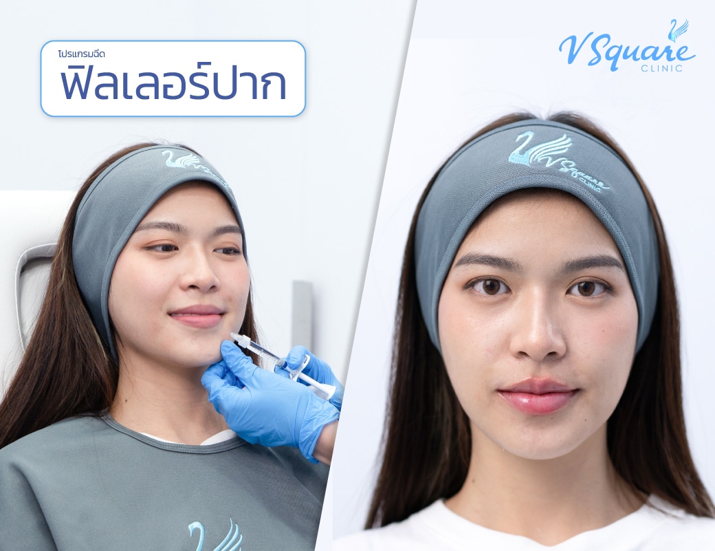 รีวิวฉีดฟิลเลอร์ปาก