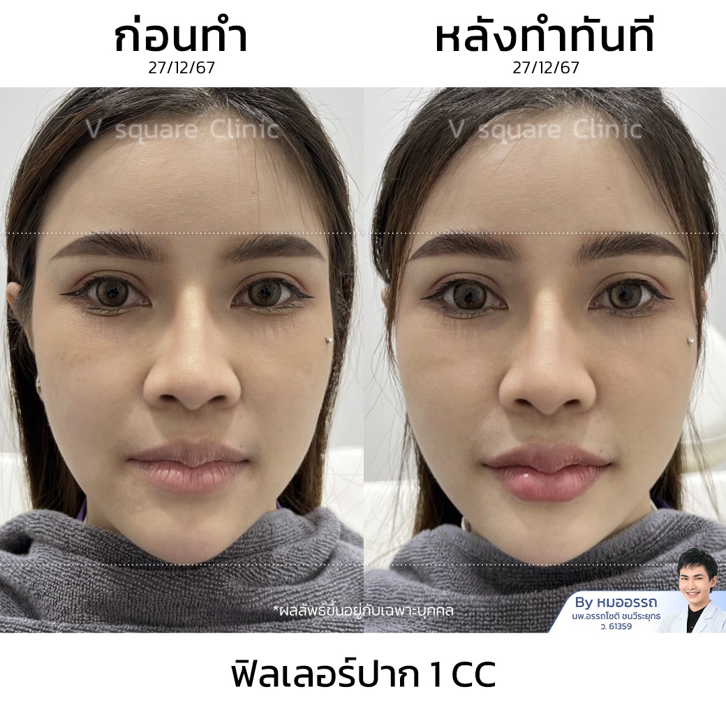 รีวิวฉีดฟิลเลอร์ปาก_สุภามาศ ภูวิเศษ