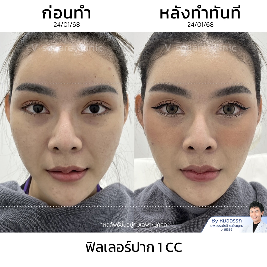 รีวิวฉีดฟิลเลอร์ปาก_เกวลี จิวเจริญ