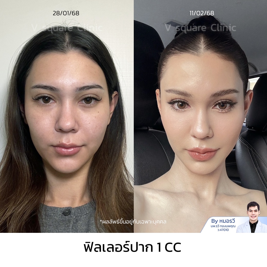 รีวิวฉีดฟิลเลอร์ปาก_เอมี่