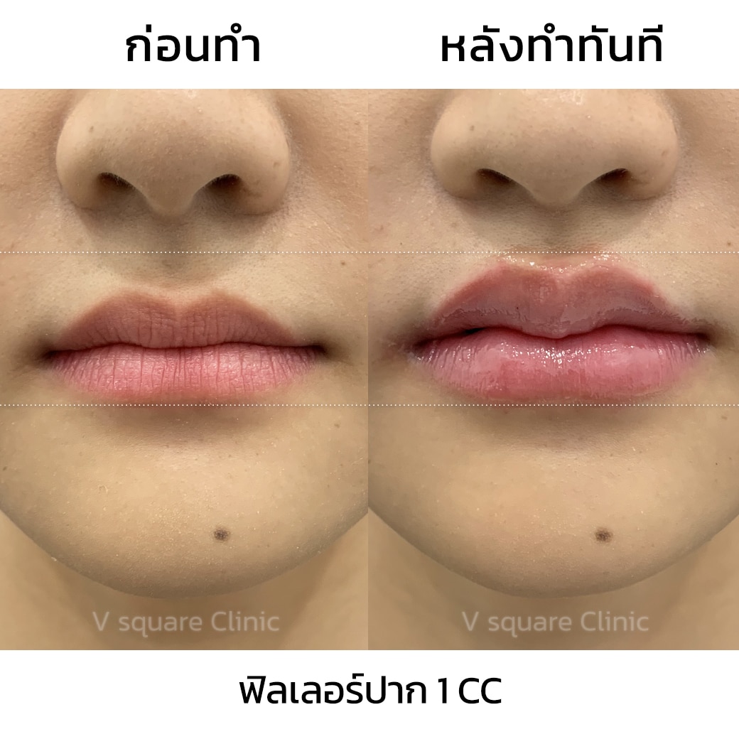 รีวิวฉีดฟิลเลอร์ปากเคสหมอนุ่น_พัสสา