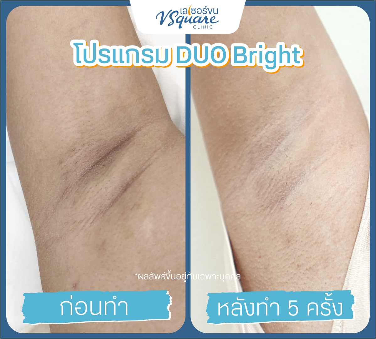 รีวิวผลลัพธ์ Yag Reju Duo Bright ก่อนทำ-หลังทำ