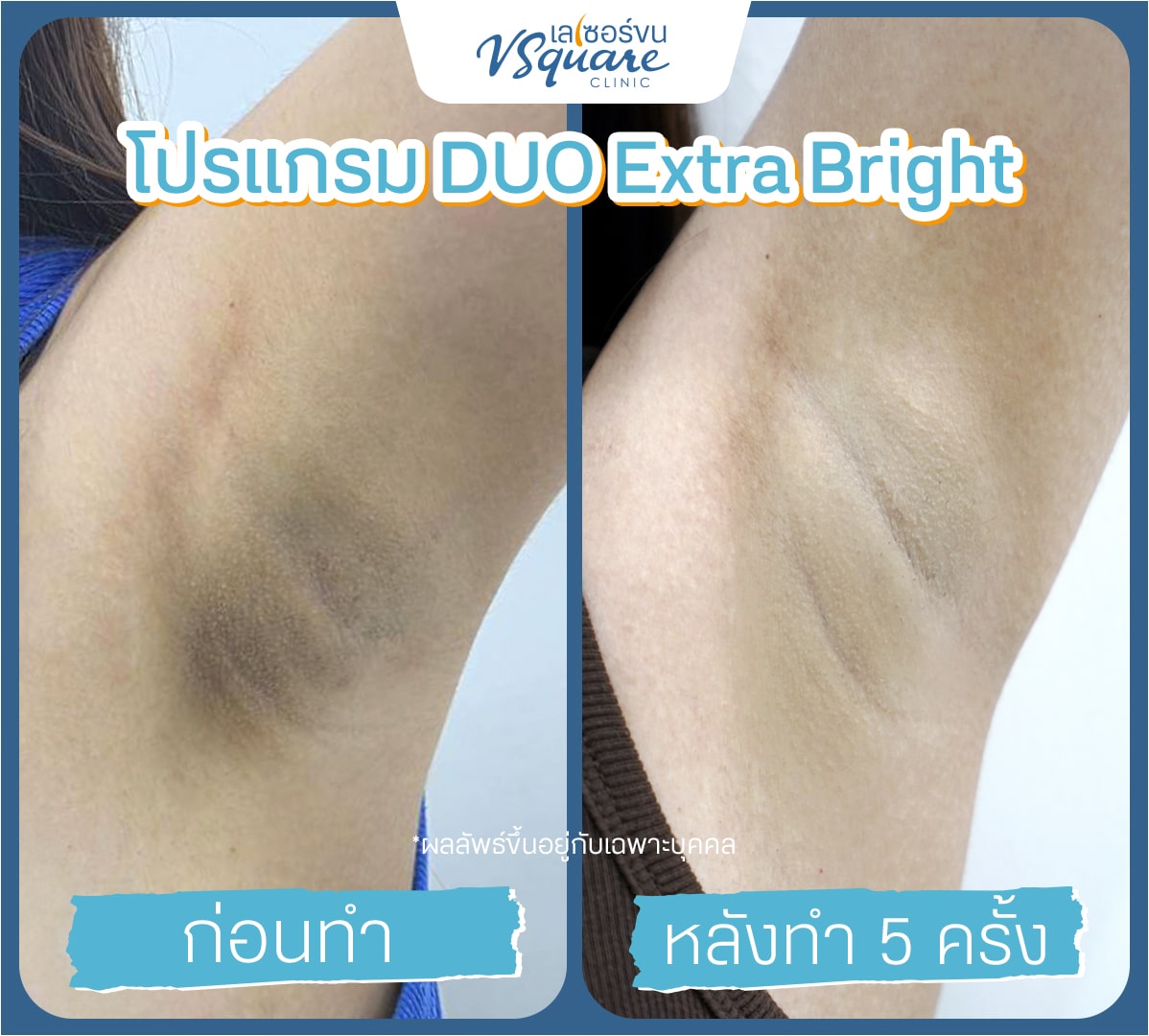รีวิวผลลัพธ์ Yag Reju Duo Extra Brigh