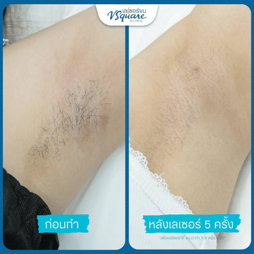 รีวิวเลเซอร์รักแร้