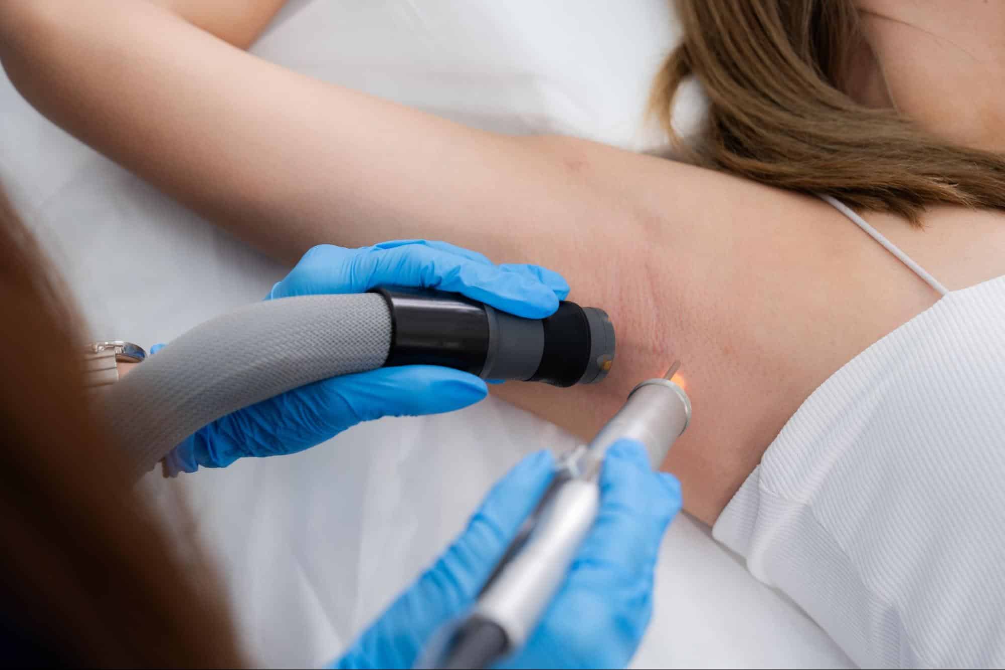 เครื่องเลเซอร์ขนรักแร้