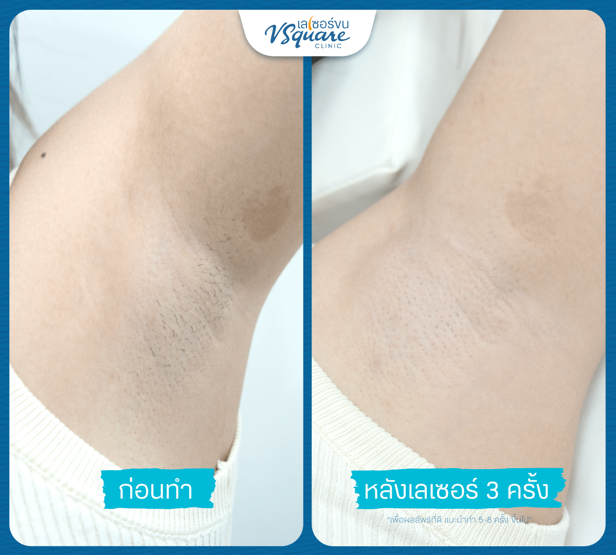 เครื่องเลเซอร์ขนในคลินิก รีวิว