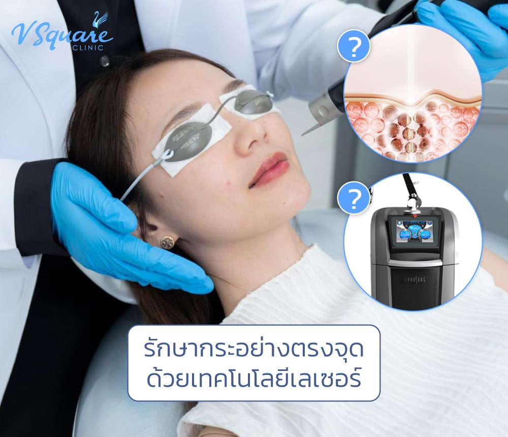 เลเซอร์กระ