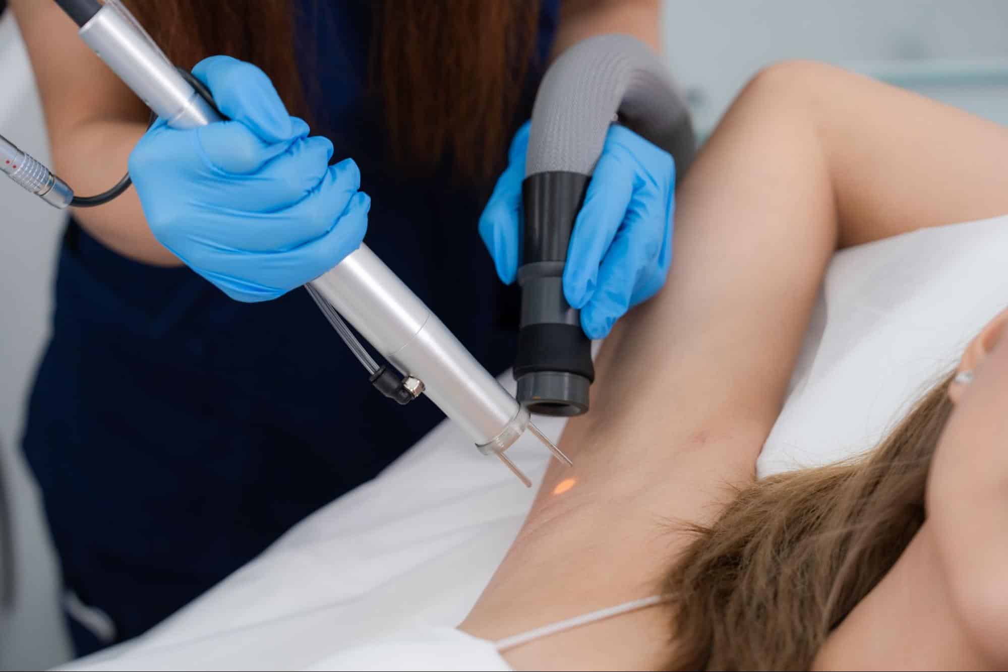 เลเซอร์รักแร้