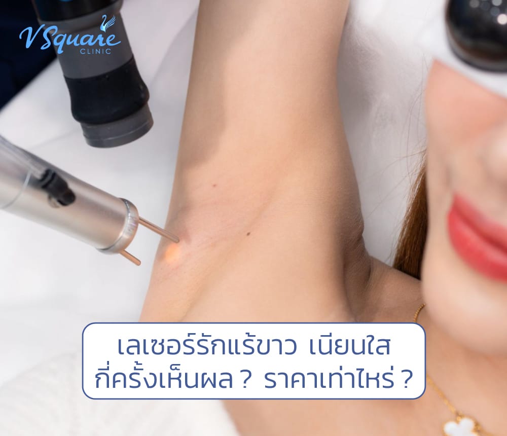 เลเซอร์รักแร้ขาว