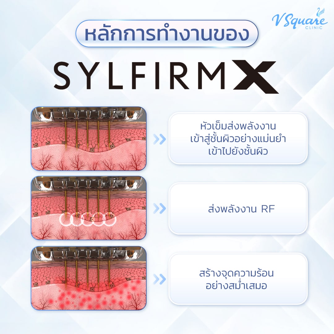 Sylfirm X Plus เลเซอร์รูขุมขน