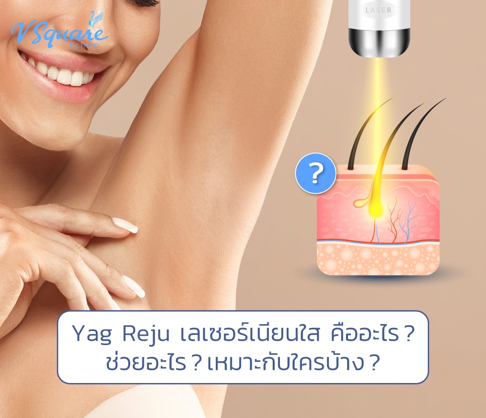 Yag Reju