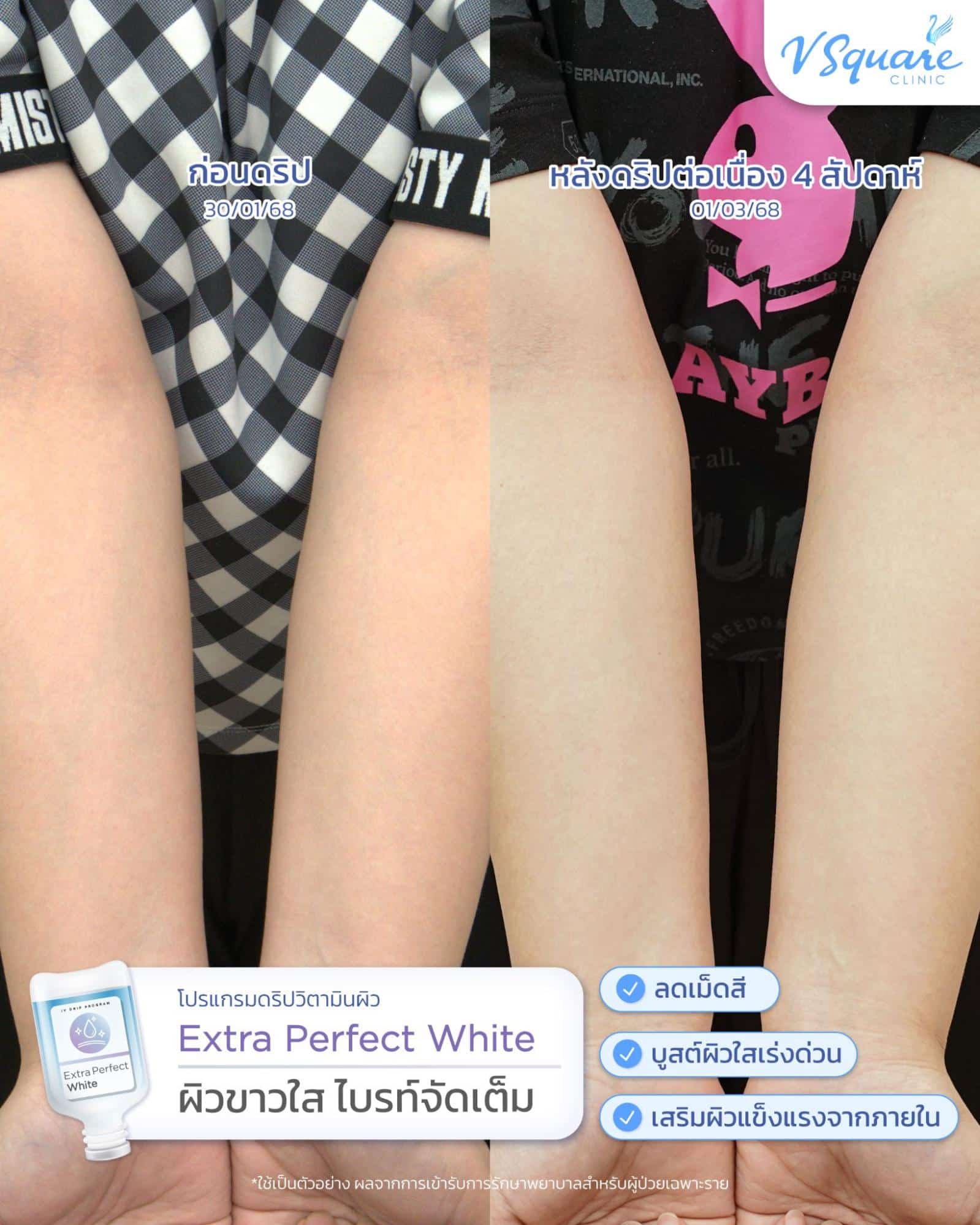 รีวิวดริปวิตามินแก้ผิวขาดน้ำ