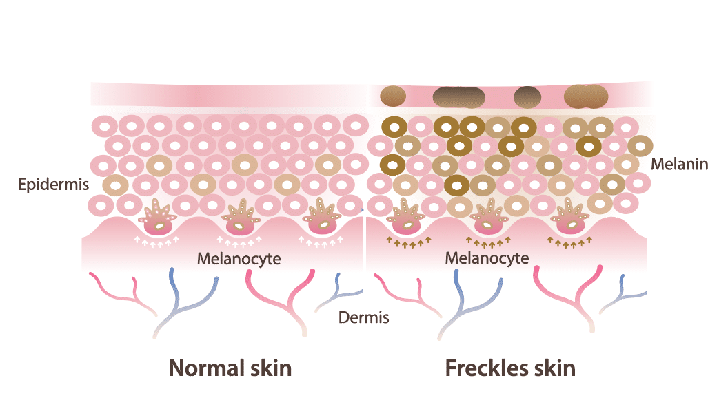 กระ (Freckles skin)
