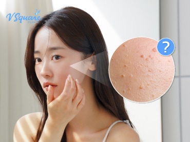 กระเนื้อ 370x277