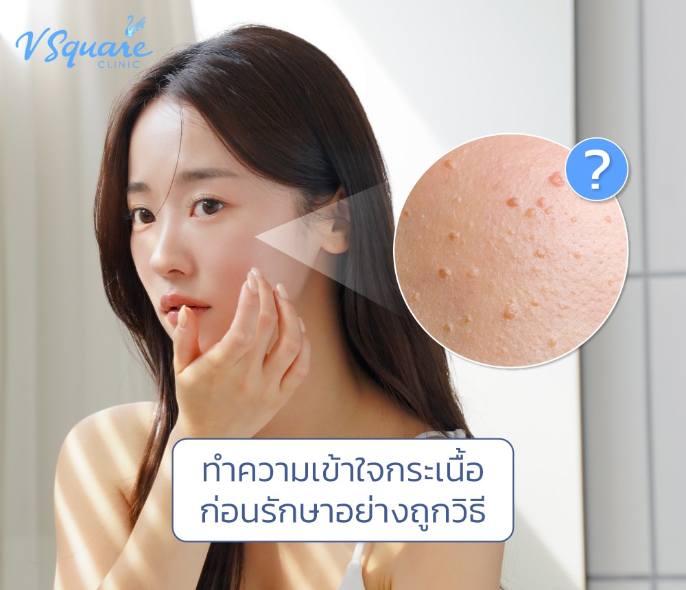 กระเนื้อ