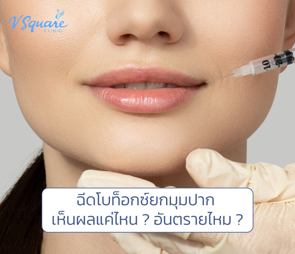 ฉีดโบท็อกยกมุมปาก