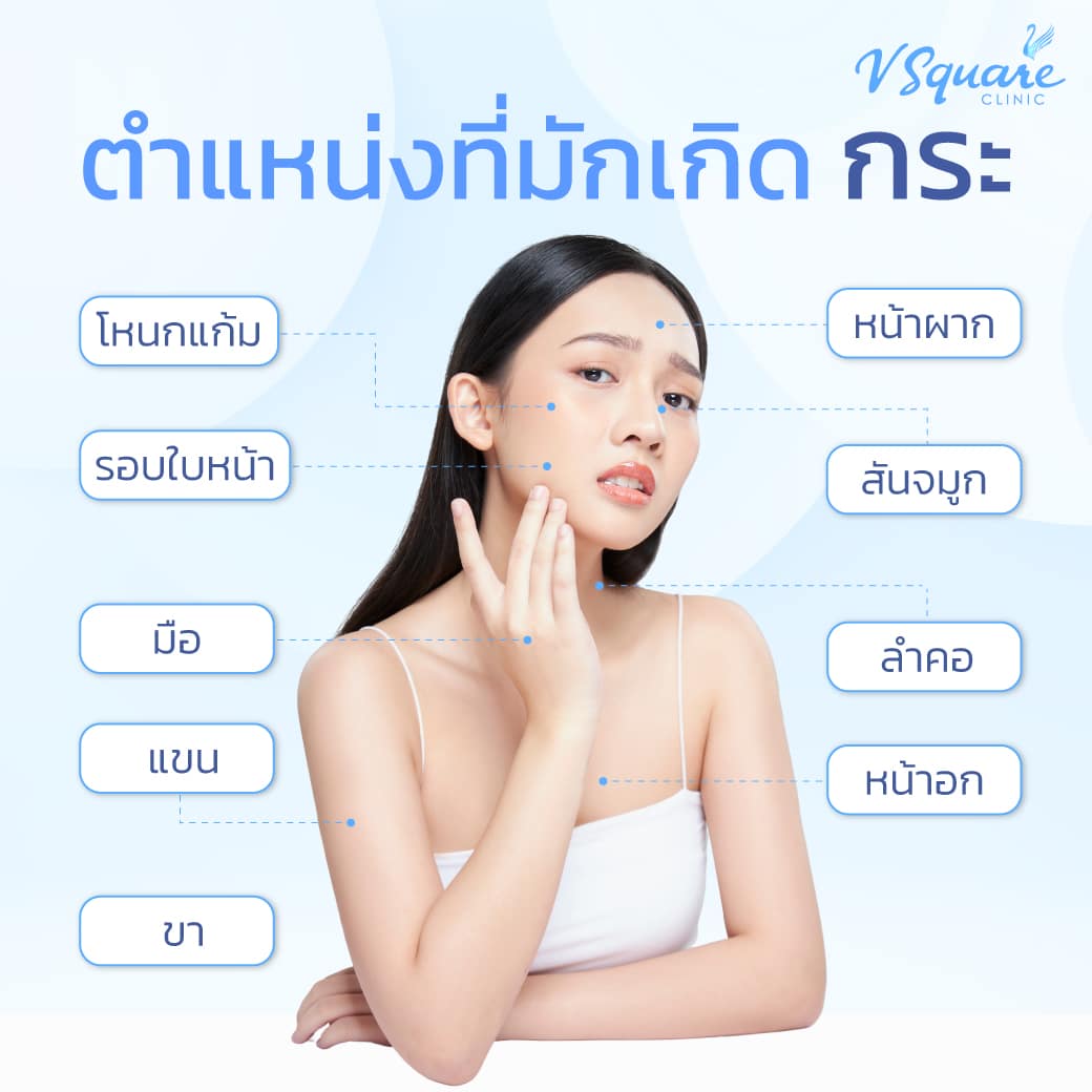 ตำแหน่งที่มักเกิดกระ