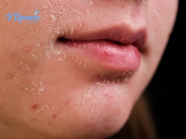 ผิวขาดน้ำ 370x277