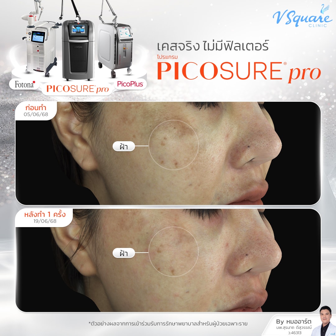 รีวิว Pico Laser ก่อน-หลังทำ