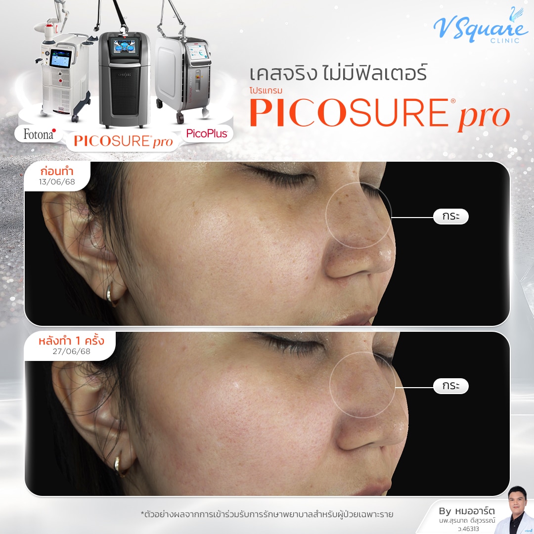 รีวิว Pico Laser ก่อน-หลังทำ