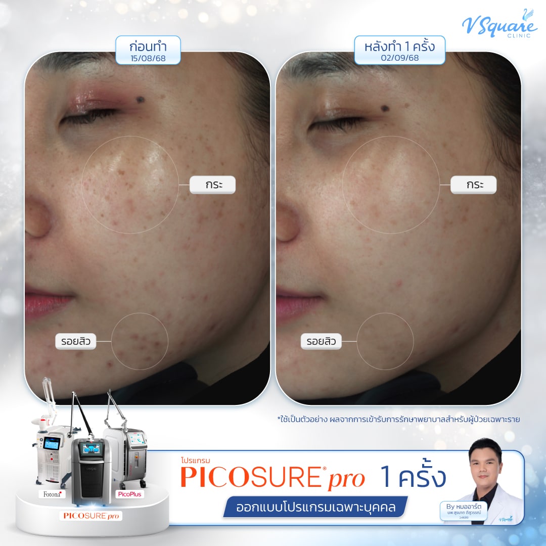 รีวิว Pico Laser ก่อน-หลังทำ