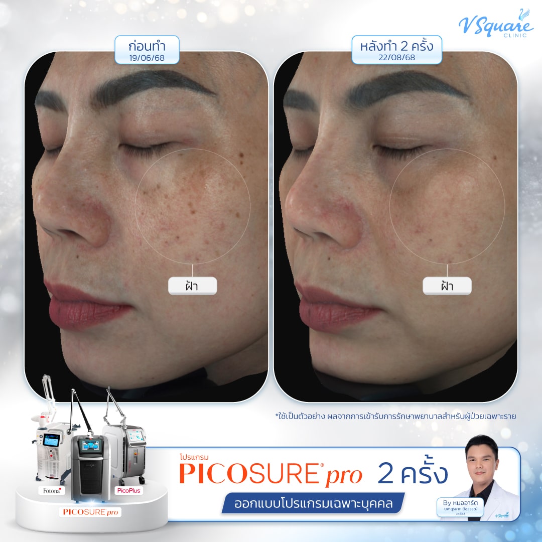 รีวิว Pico Laser ก่อน-หลังทำ