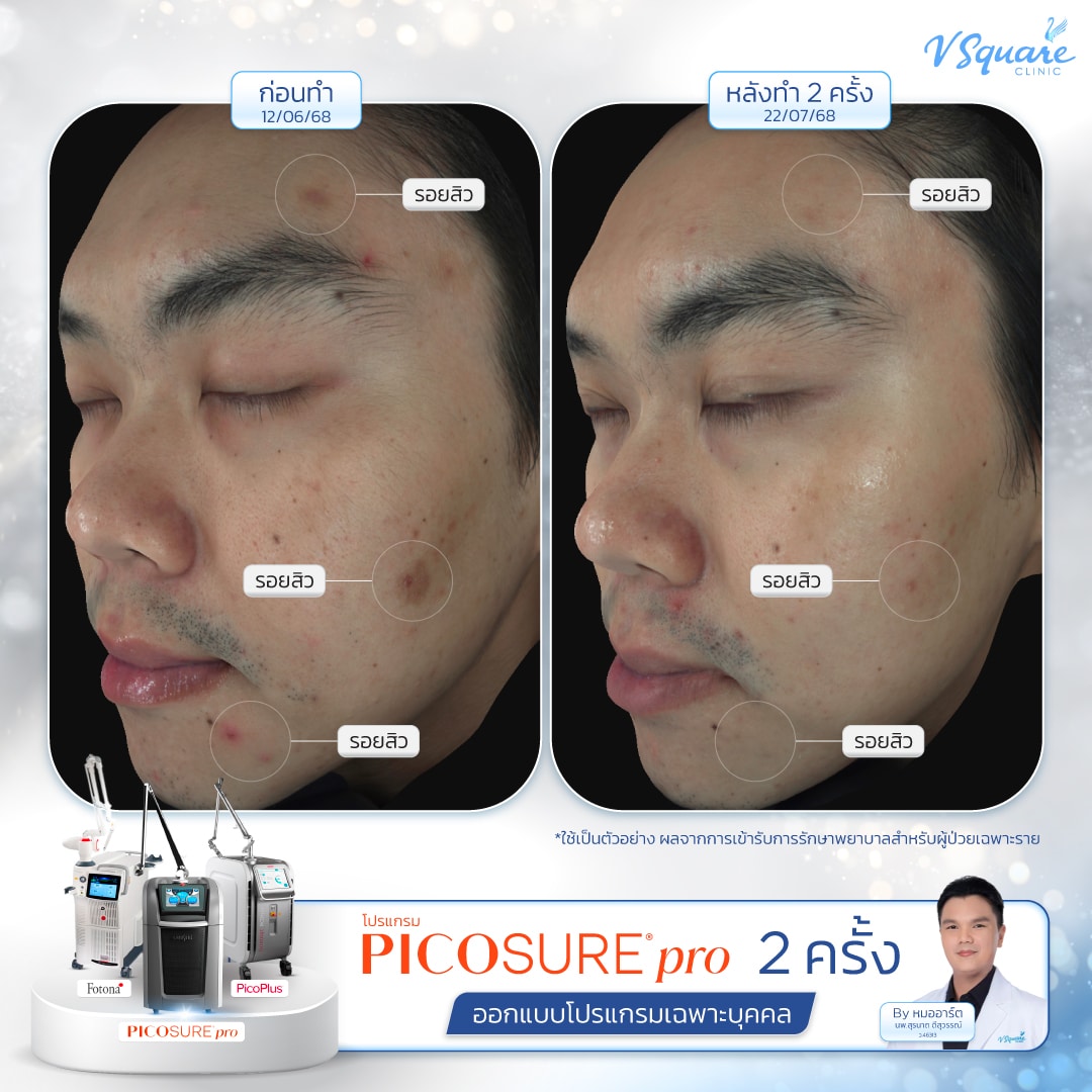 รีวิว Pico Laser ก่อน-หลังทำ